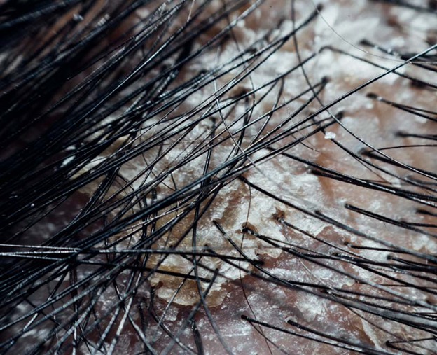 dandruff treatment
